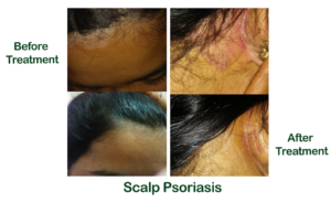Scalp Psoriasis Treatent